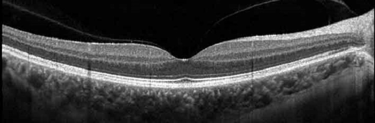 OCT retinal scan image