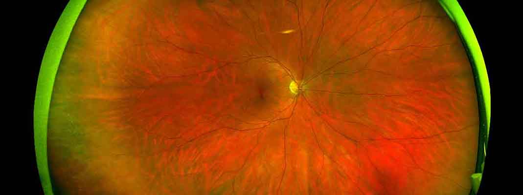 Optomap ultra-widefield retinal image